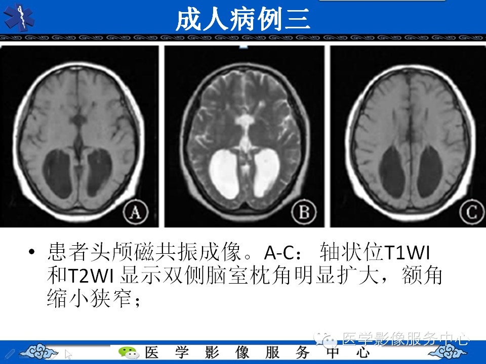 侧脑室枕角扩大畸形