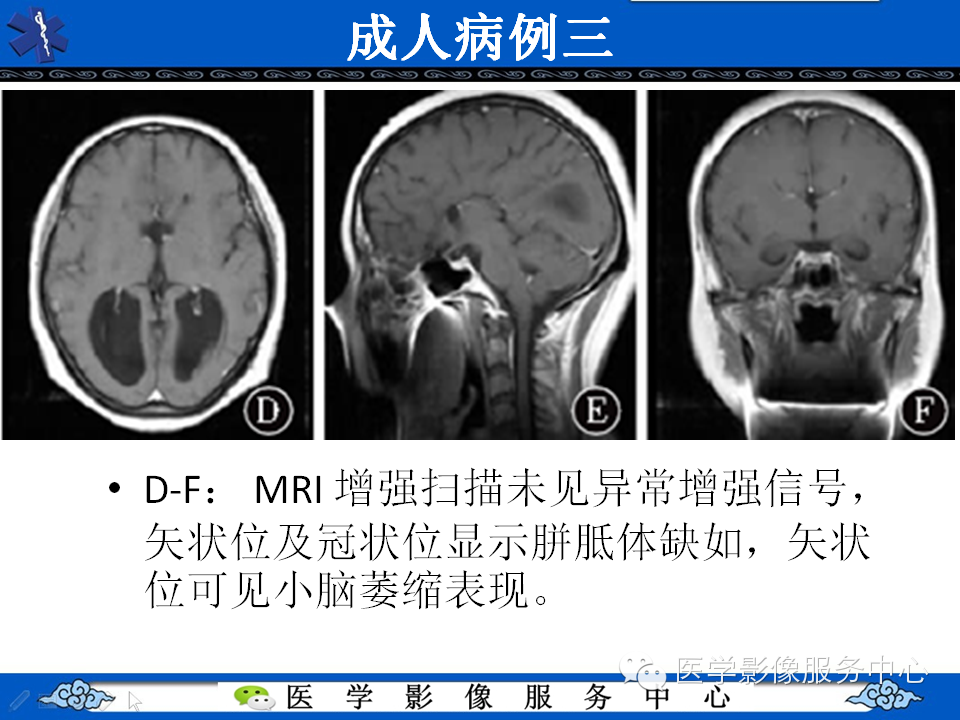侧脑室枕角扩大畸形