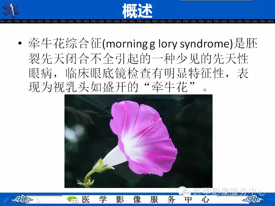 牵牛花综合征的CT和MRI诊断