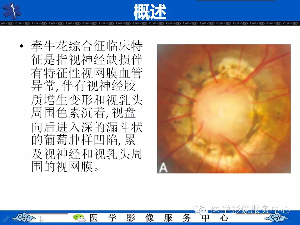 牵牛花综合征的CT和MRI诊断