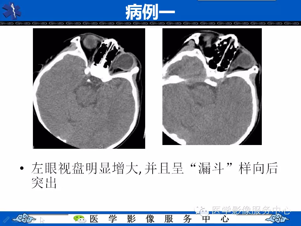 牵牛花综合征的CT和MRI诊断