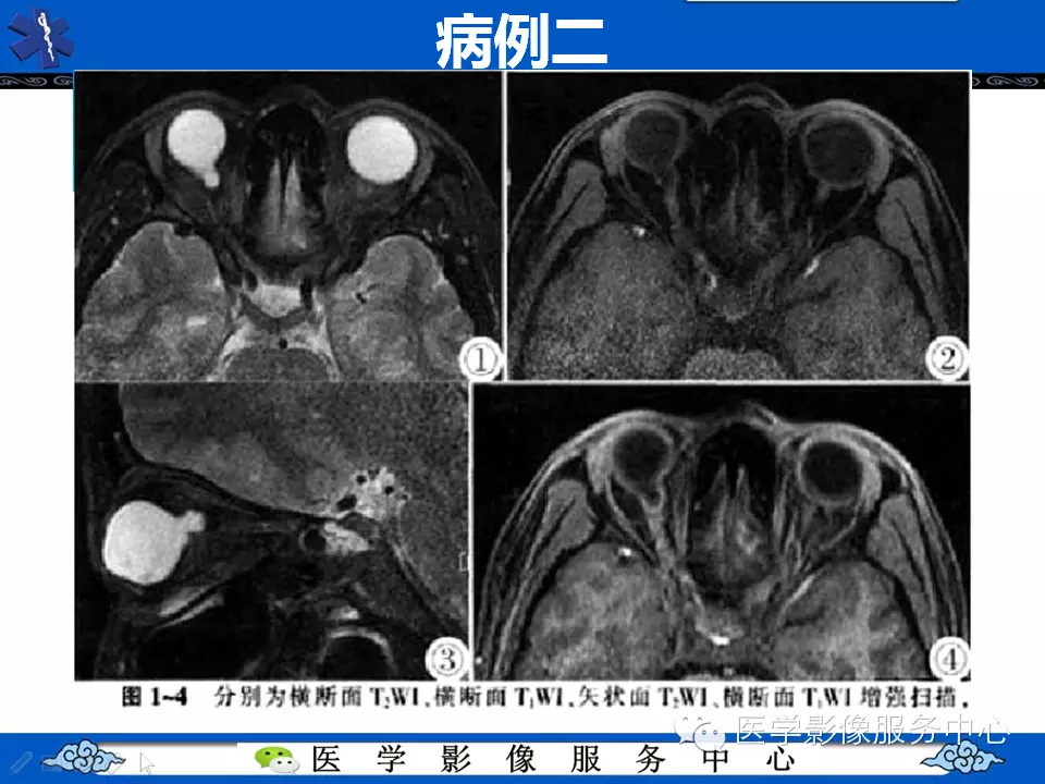 牵牛花综合征的CT和MRI诊断