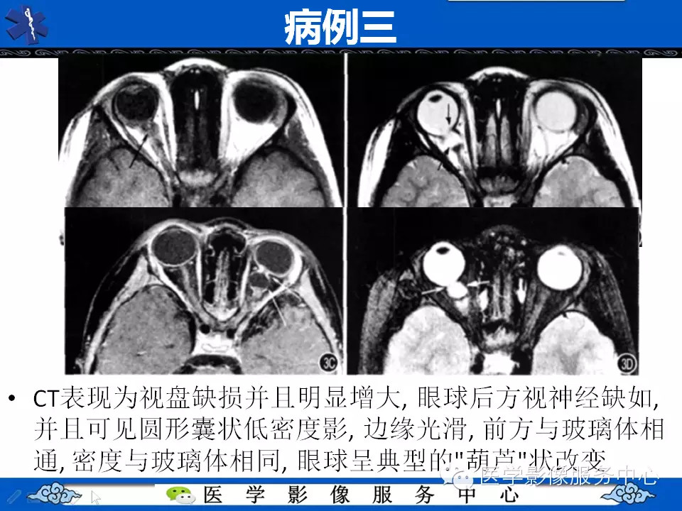 牵牛花综合征的CT和MRI诊断