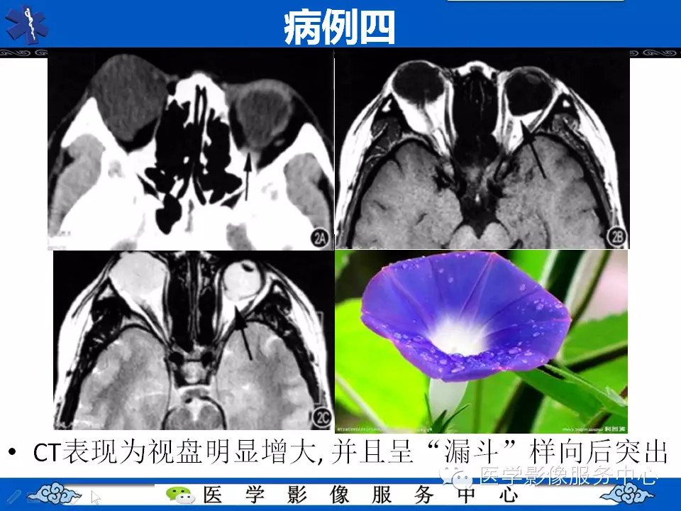 牵牛花综合征的CT和MRI诊断