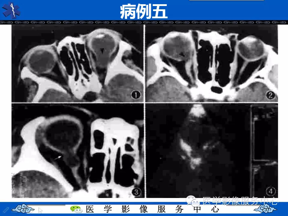 牵牛花综合征的CT和MRI诊断