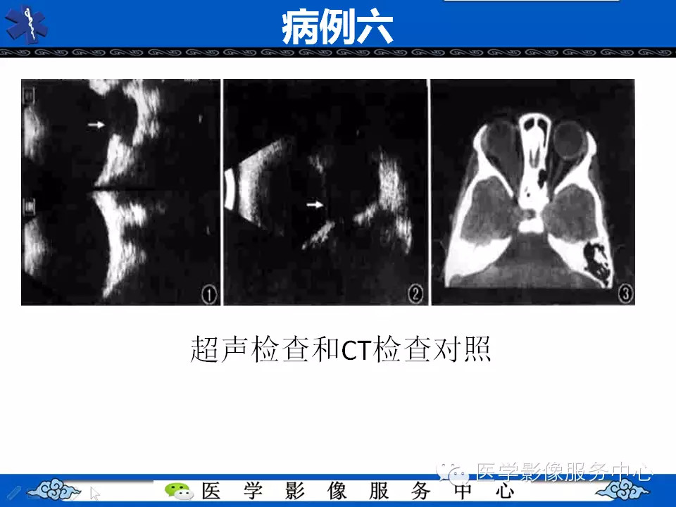 牵牛花综合征的CT和MRI诊断