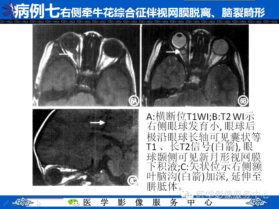 牵牛花综合征的CT和MRI诊断
