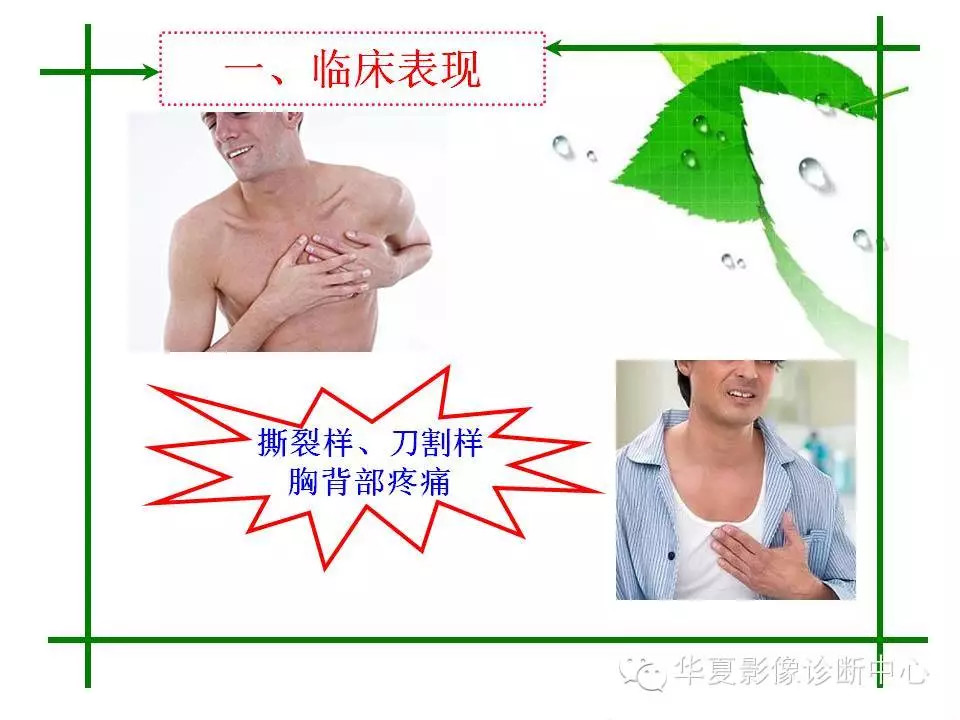 主动脉夹层的影像诊断