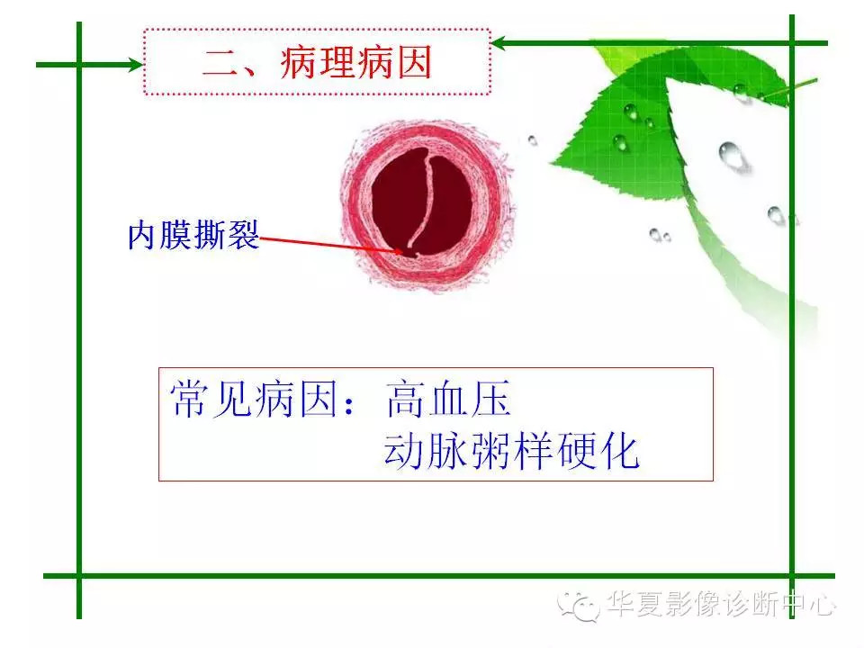 主动脉夹层的影像诊断