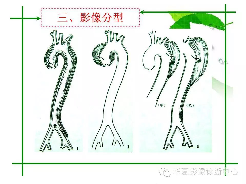 主动脉夹层的影像诊断
