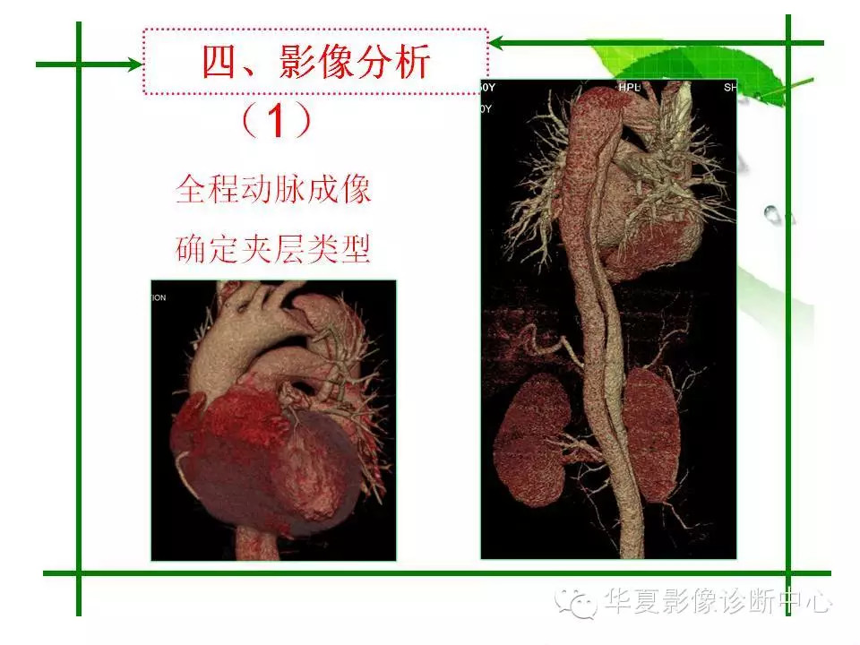 主动脉夹层的影像诊断
