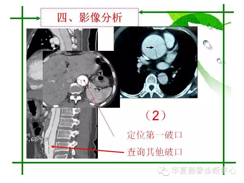 主动脉夹层的影像诊断
