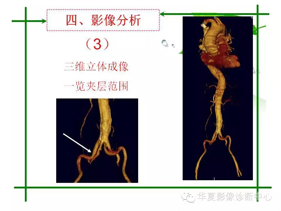 主动脉夹层的影像诊断
