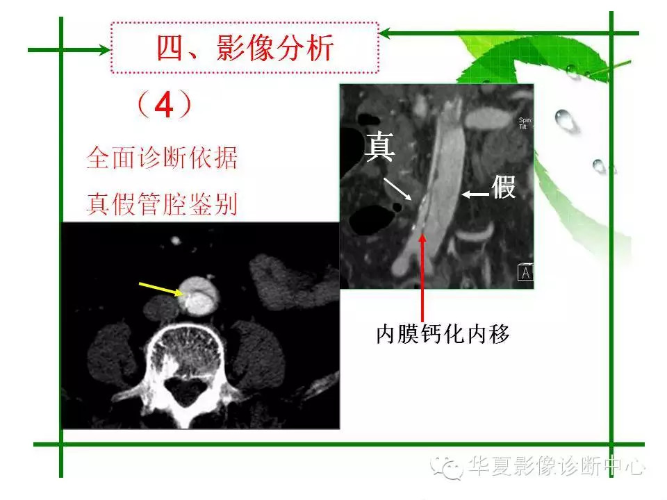 主动脉夹层的影像诊断