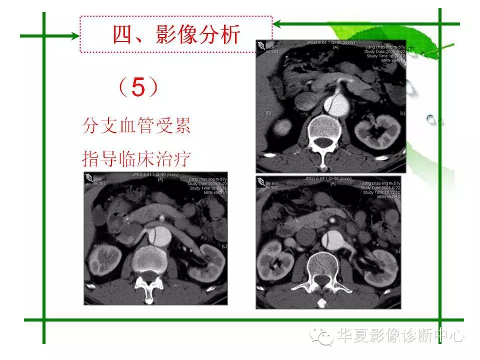 主动脉夹层的影像诊断