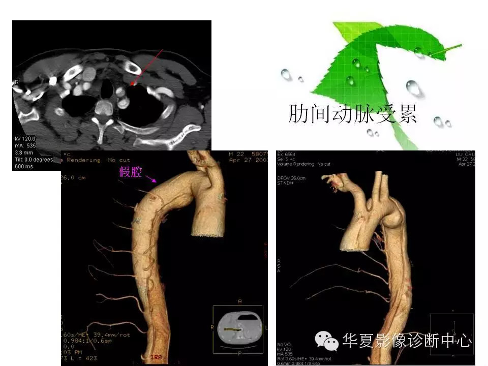 主动脉夹层的影像诊断