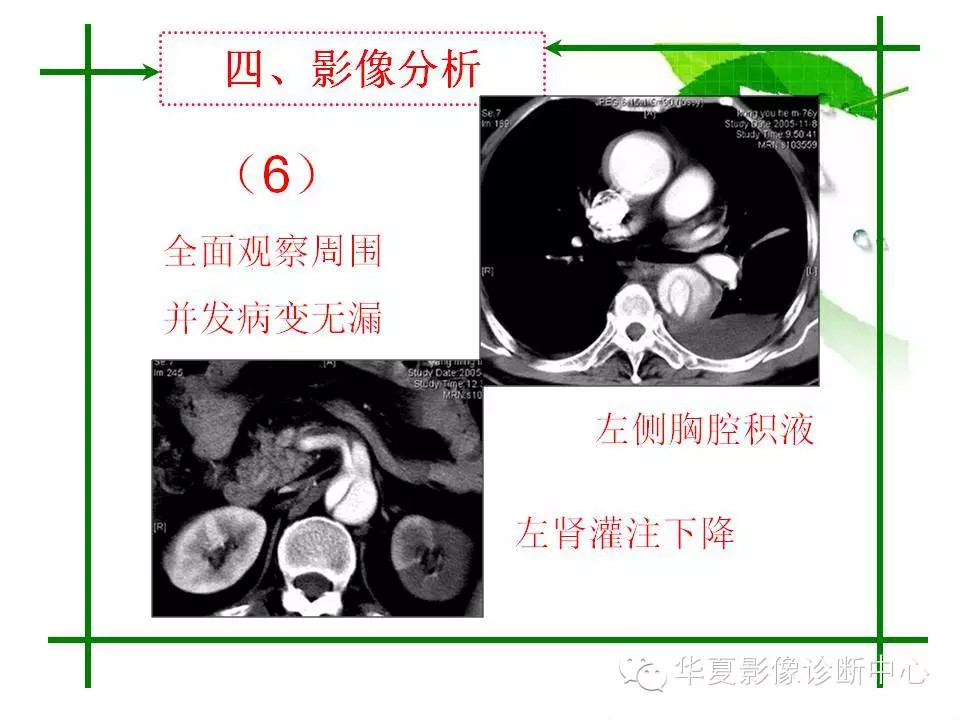 主动脉夹层的影像诊断
