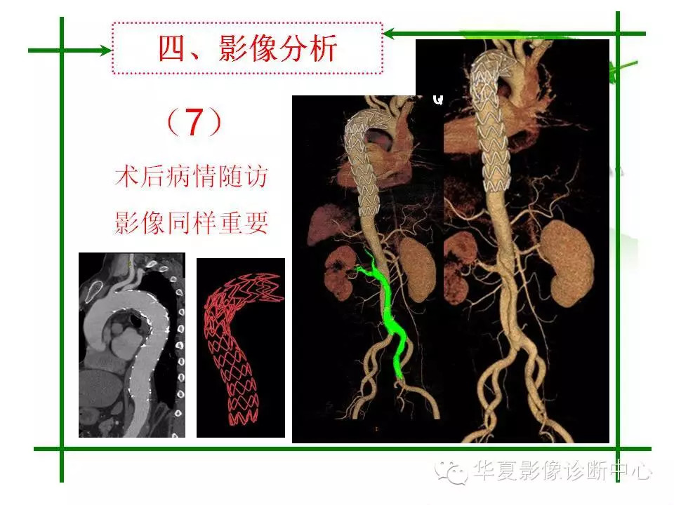 主动脉夹层的影像诊断