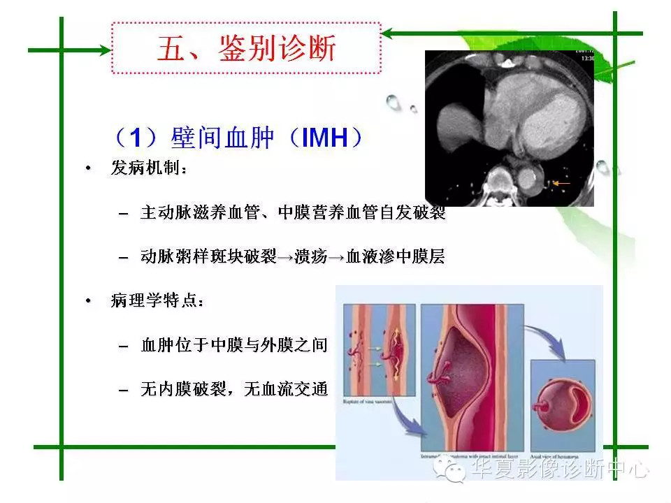 主动脉夹层的影像诊断