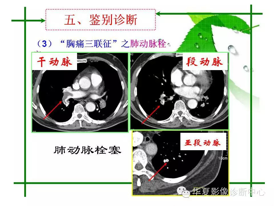 主动脉夹层的影像诊断