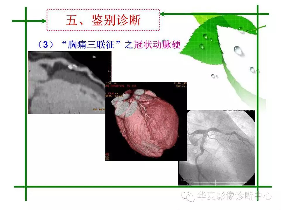 主动脉夹层的影像诊断