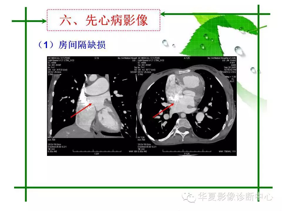 主动脉夹层的影像诊断