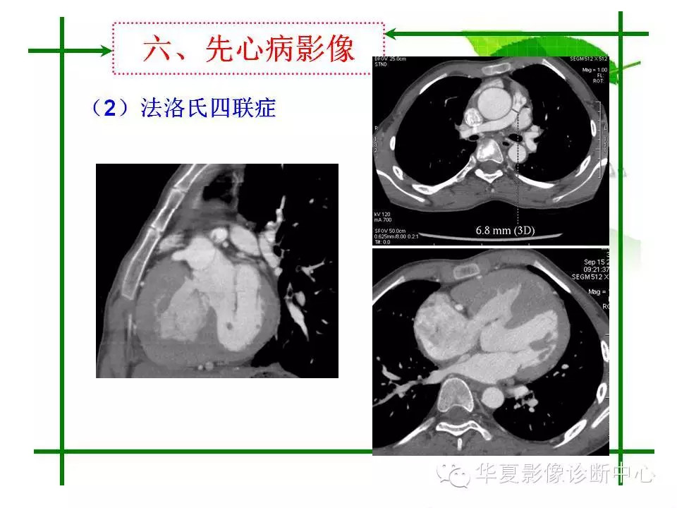 主动脉夹层的影像诊断