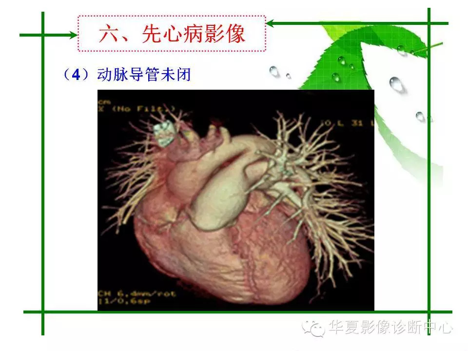 主动脉夹层的影像诊断