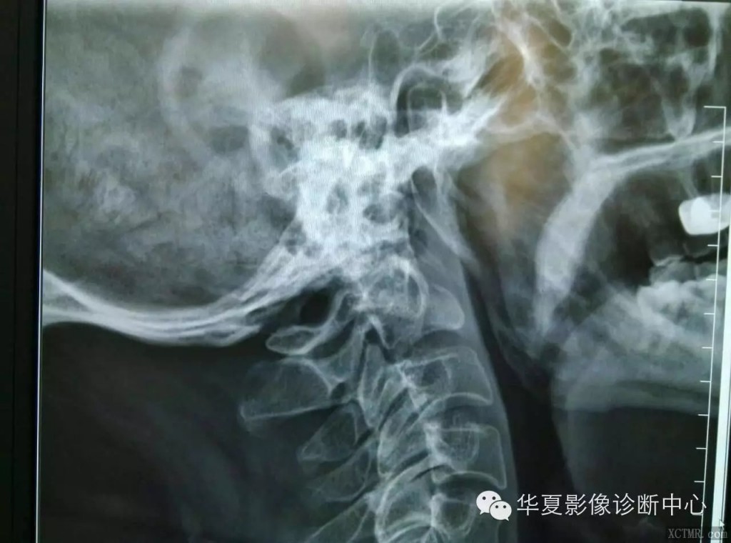 颅底凹陷症