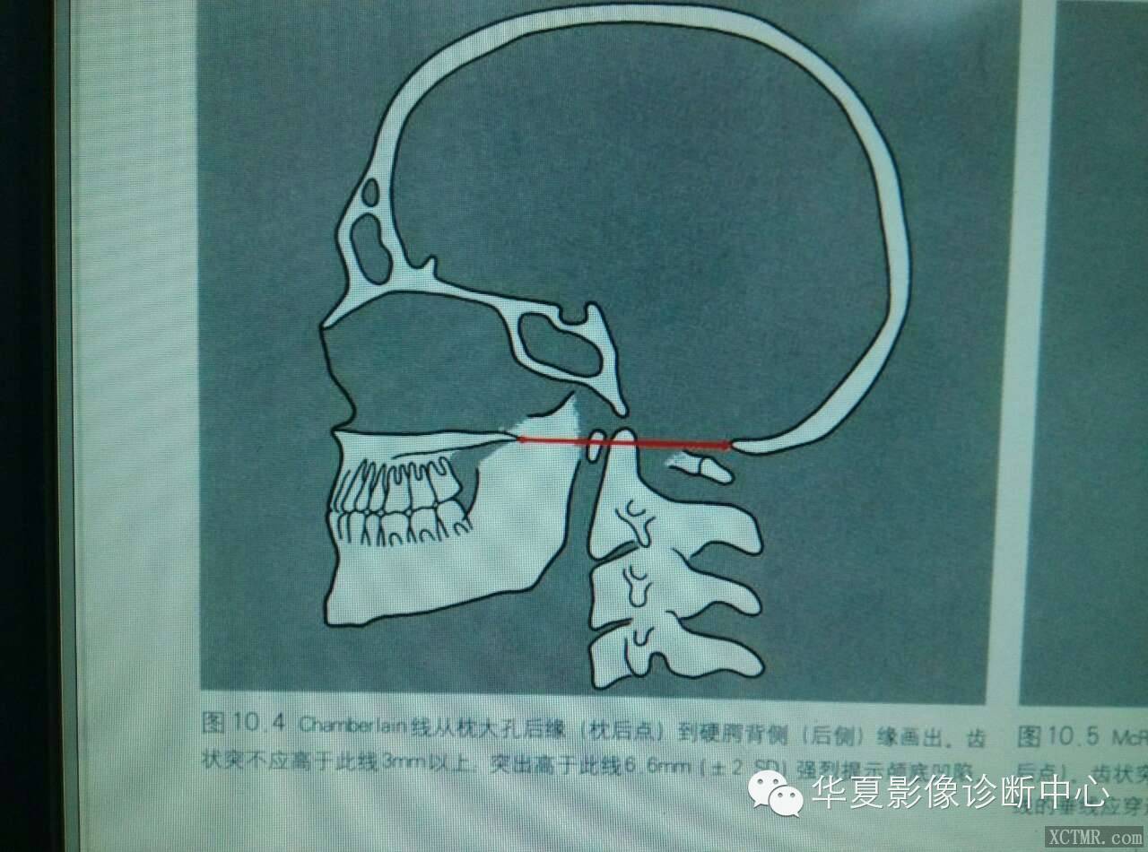 颅底凹陷症 颅底凹陷症