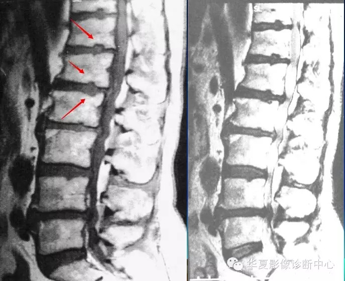 换个角度看椎间盘突出 换个角度看椎间盘突出