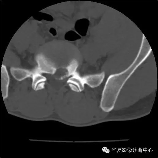 换个角度看椎间盘突出 换个角度看椎间盘突出