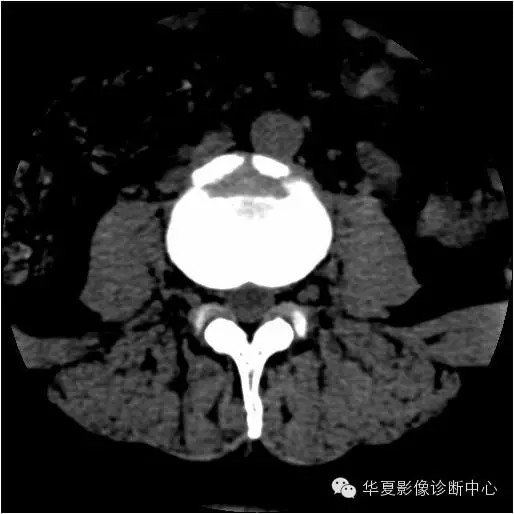 换个角度看椎间盘突出 换个角度看椎间盘突出
