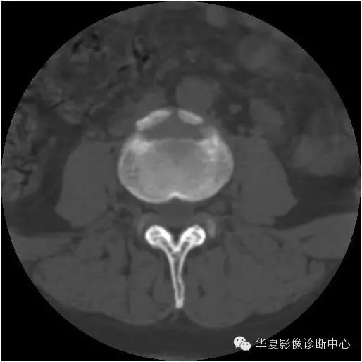 换个角度看椎间盘突出 换个角度看椎间盘突出