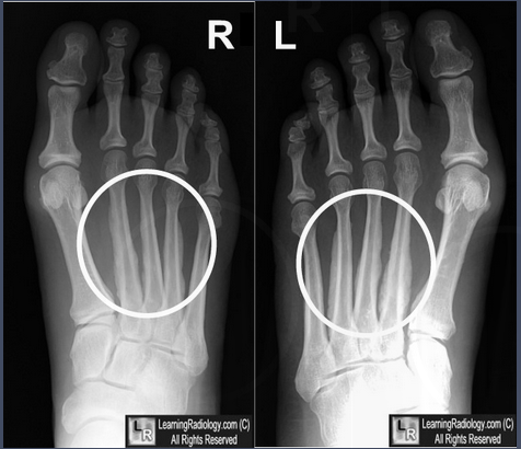 【病例学习】 甲状腺性肢端肥厚一例X线诊断 【病例学习】 甲状腺性肢端肥厚一例X线诊断