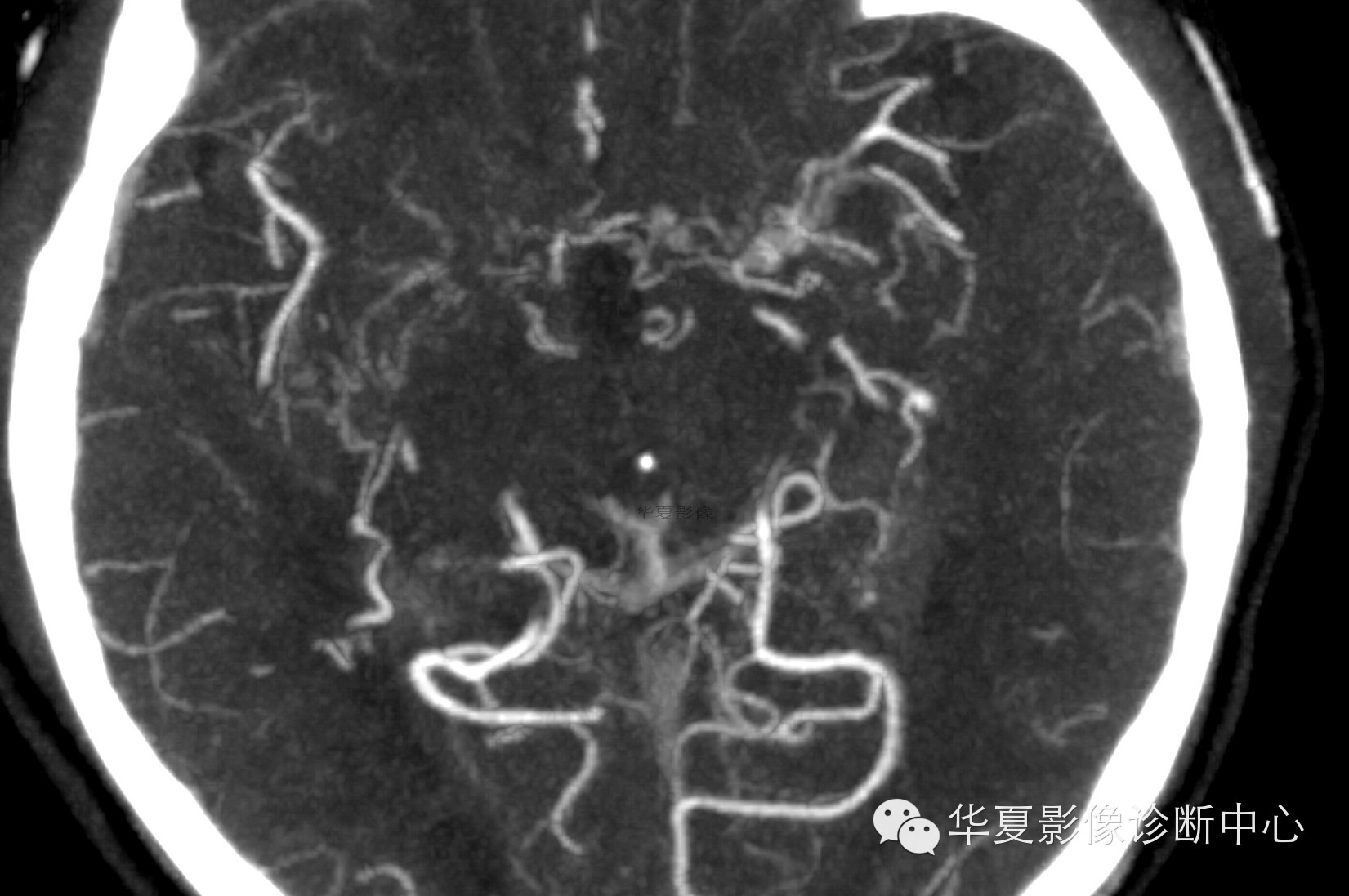 【病例学习】烟雾病一例影像诊断 【病例学习】烟雾病一例影像诊断