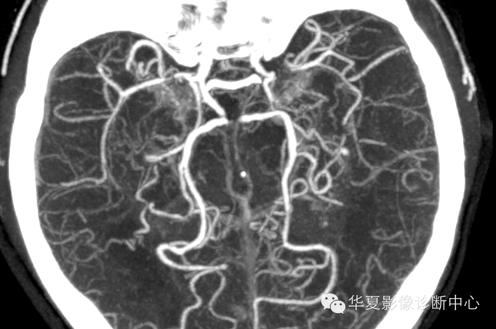 【病例学习】烟雾病一例影像诊断 【病例学习】烟雾病一例影像诊断