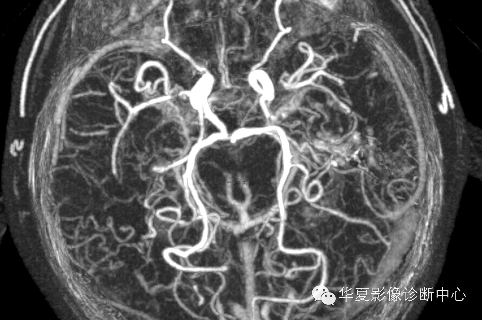【病例学习】烟雾病一例影像诊断 【病例学习】烟雾病一例影像诊断