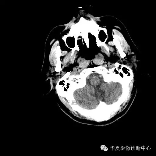 【病例学习】烟雾病一例影像诊断 【病例学习】烟雾病一例影像诊断