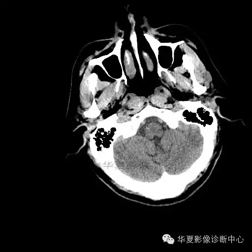 【病例学习】烟雾病一例影像诊断 【病例学习】烟雾病一例影像诊断