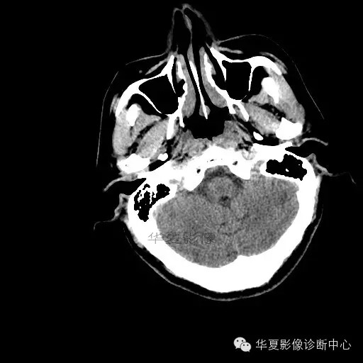 【病例学习】烟雾病一例影像诊断 【病例学习】烟雾病一例影像诊断