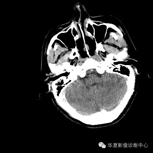 【病例学习】烟雾病一例影像诊断 【病例学习】烟雾病一例影像诊断