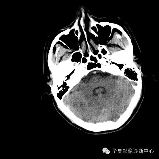 【病例学习】烟雾病一例影像诊断 【病例学习】烟雾病一例影像诊断