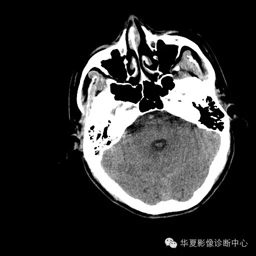 【病例学习】烟雾病一例影像诊断 【病例学习】烟雾病一例影像诊断