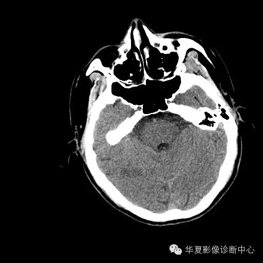 【病例学习】烟雾病一例影像诊断 【病例学习】烟雾病一例影像诊断