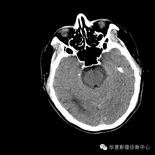 【病例学习】烟雾病一例影像诊断 【病例学习】烟雾病一例影像诊断