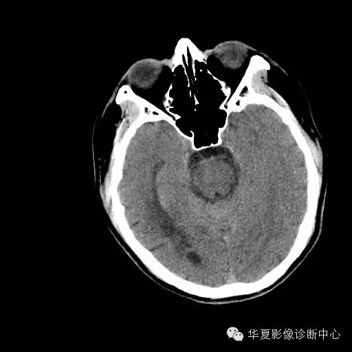 【病例学习】烟雾病一例影像诊断 【病例学习】烟雾病一例影像诊断