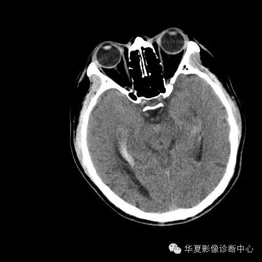 【病例学习】烟雾病一例影像诊断 【病例学习】烟雾病一例影像诊断