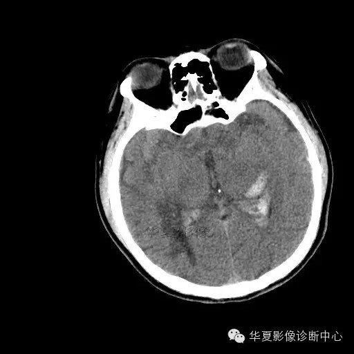 【病例学习】烟雾病一例影像诊断 【病例学习】烟雾病一例影像诊断