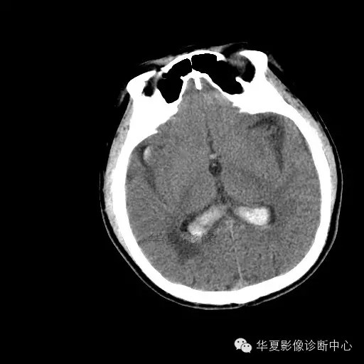 【病例学习】烟雾病一例影像诊断 【病例学习】烟雾病一例影像诊断